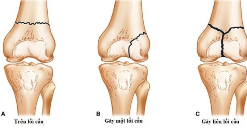 phục hồi chức năng gãy đầu dưới xương đùi