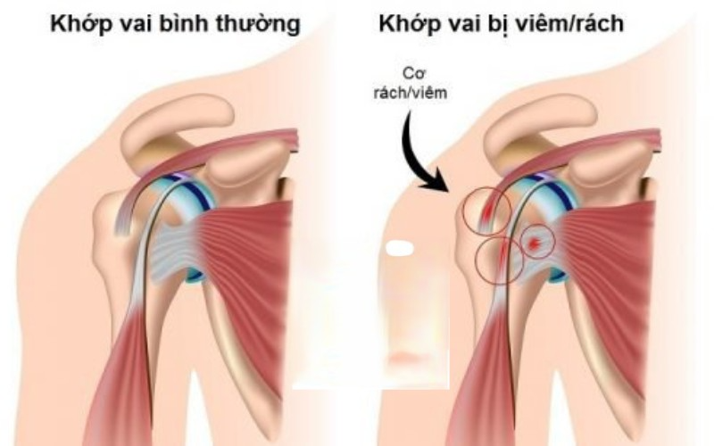 Cơ nhị đầu cánh tay