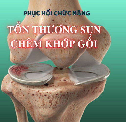 tổn thương sụn chêm khớp gối