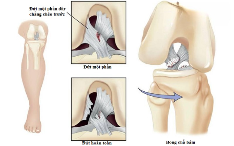 Đứt bán phần dây chằng chéo trước