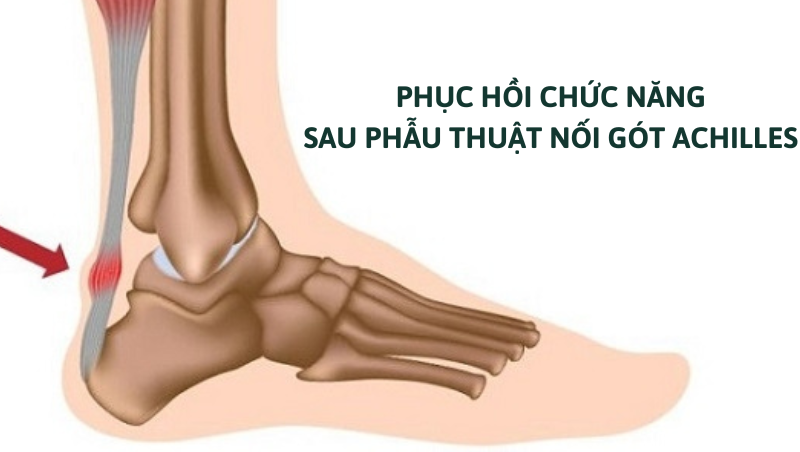 sau phẫu thuật nối gót Achilles