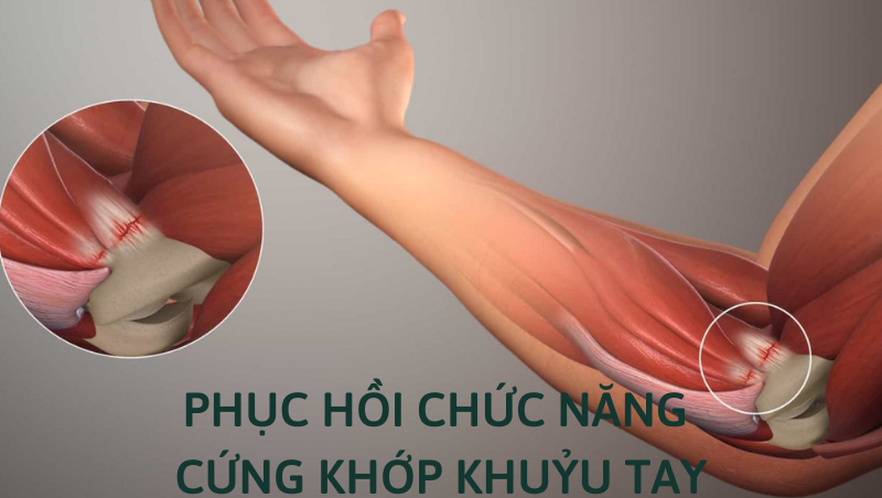 cứng khớp khuỷu tay