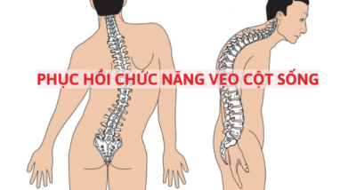 phục hồi chức năng vẹo cột sống