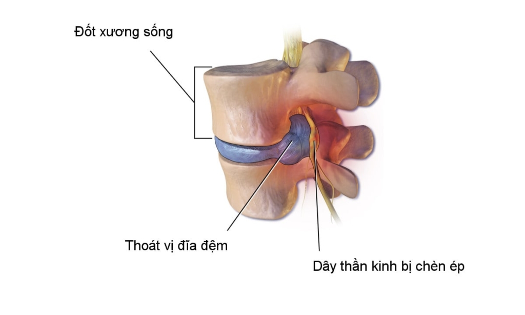 Đau thắt lưng lan xuống chân có nguy hiểm không