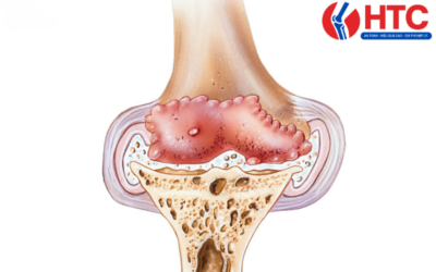 đầu gối có gai