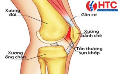 nguyên nhân mỏi khớp gối