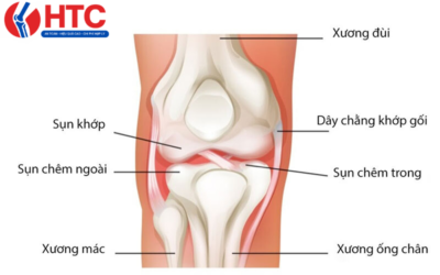 đau xương khớp gối