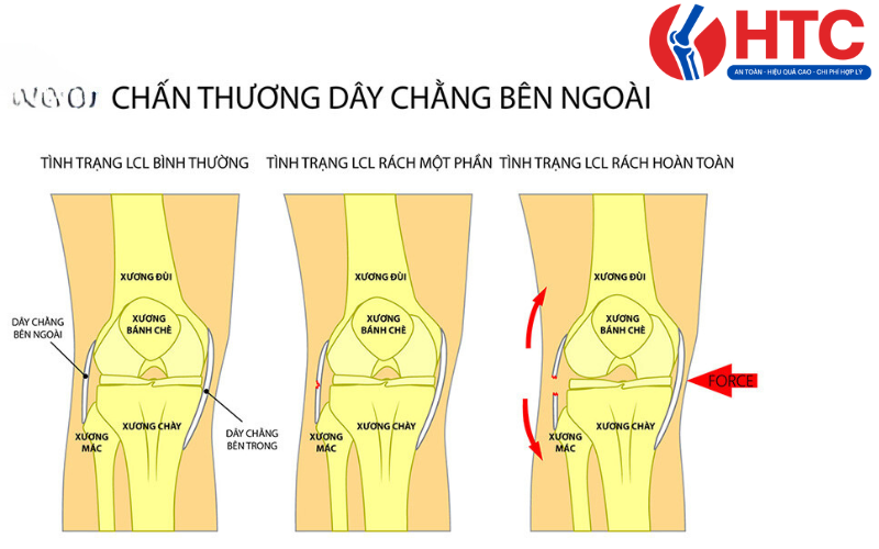 đau dây chằng ngoài khớp gối