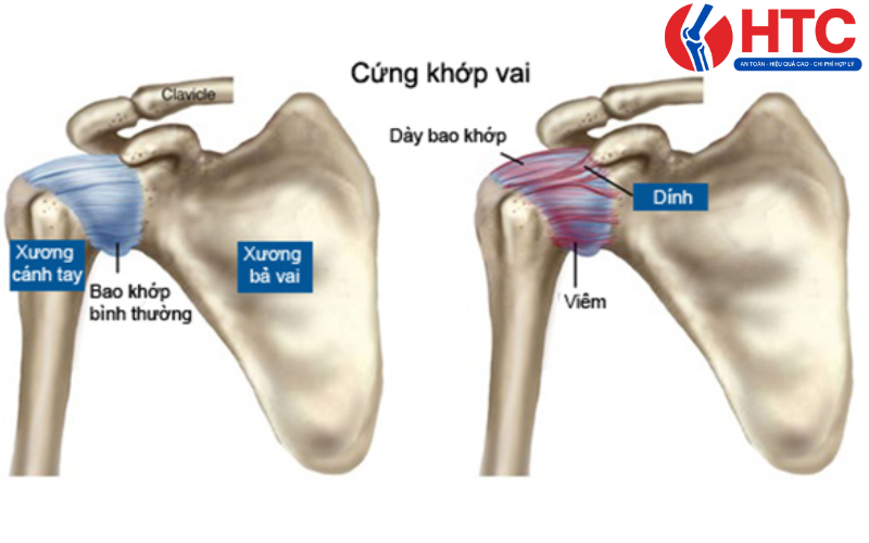 bệnh lý khớp vai