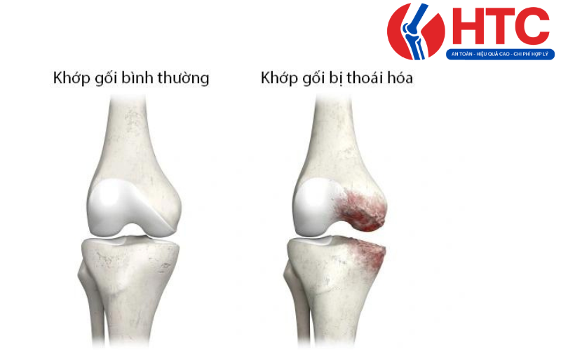 bệnh đau khớp gối ở người trung niên