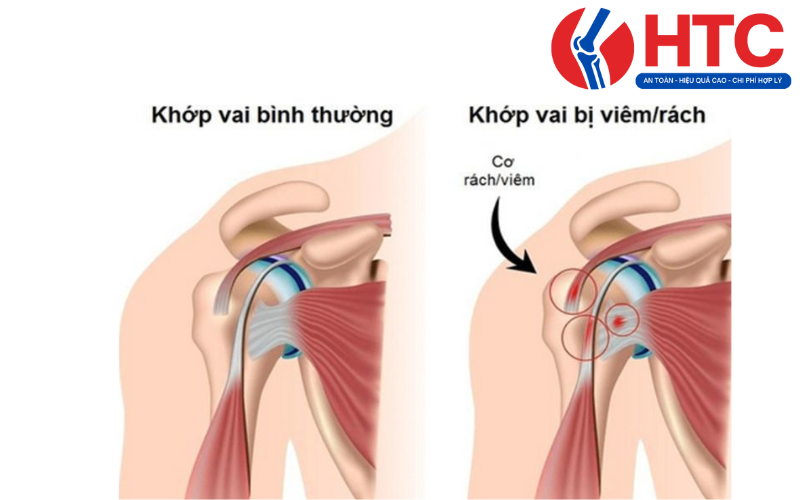 bài tập vật lý trị liệu viêm quanh khớp vai