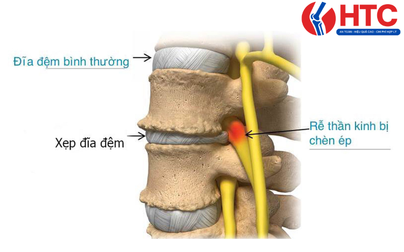 bị xẹp đĩa đệm