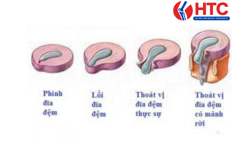 các mức độ thoát vị đĩa đệm