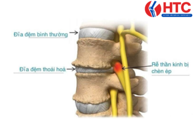 Thoái hóa đĩa đệm