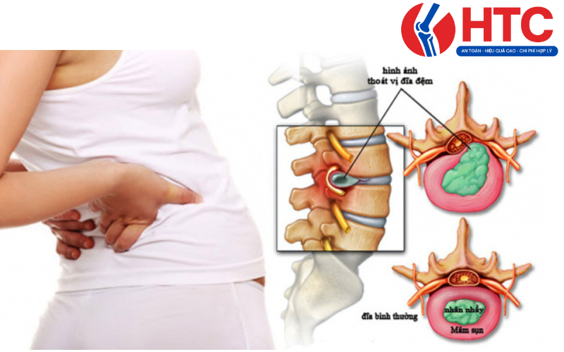 thoát vị đĩa đệm có khỏi không