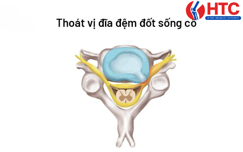 mổ thoát vị đĩa đệm cổ