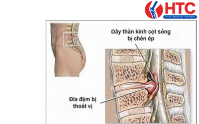 biến chứng thoát vị đĩa đệm cột sống thắt lưng