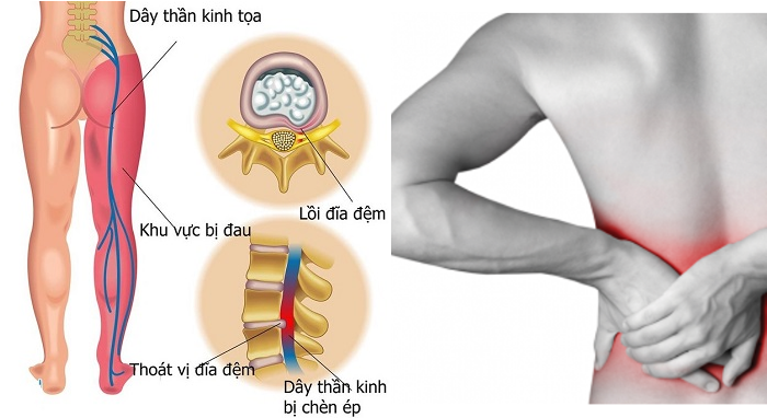 Giải thích về bệnh thoát vị đĩa đệm