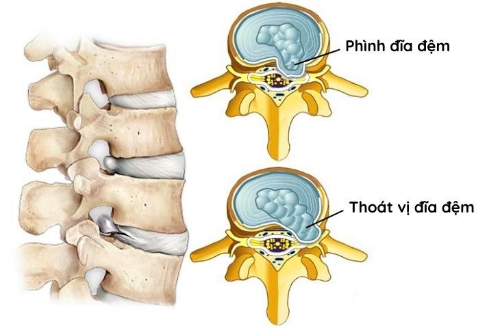 Thế nào là phồng đĩa đệm?