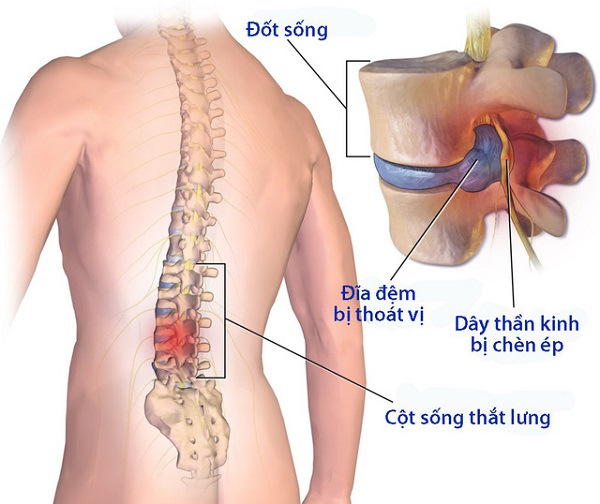 Triệu chứng phồng đĩa đệm