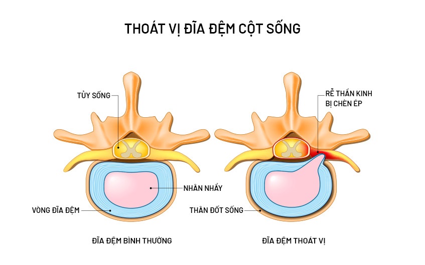 Bệnh thoát vị đĩa đệm ảnh hưởng như thế nào đến “chuyện ấy”?