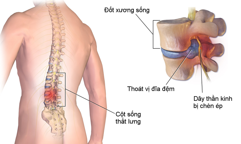 Thoát vị đĩa đệm có thể tái phát