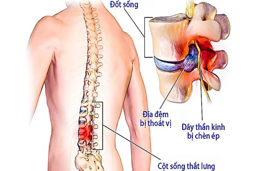 triệu chứng thoát vị đĩa đệm