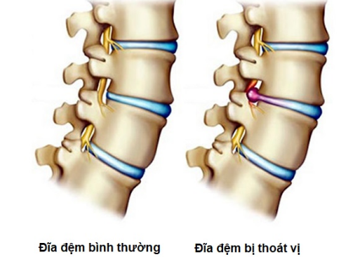 Thoát vị đĩa đệm là gì?