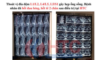 THOÁT VỊ ĐĨA ĐỆM L1-L2 L4-L5 L5-S1