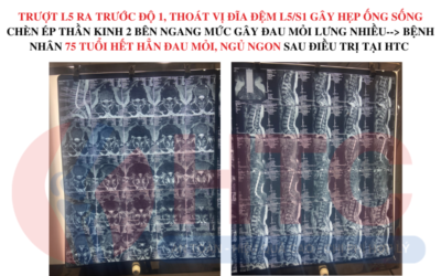 trượt L5 ra trước độ 1, thoát vị đĩa đệm L5/S1 gây hẹp ống sống chèn ép thần kinh 2 bên ngang mức gây đau mỏi lưng nhiều--> bệnh nhân 75 tuổi hết hẳn đau mỏi, ngủ ngon sau điều trị tại htc