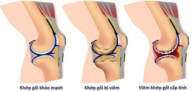 Tổng quan về đau khớp gối sau khi ngủ dậy