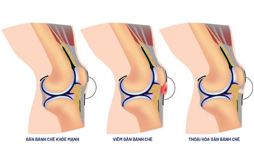 Tổng quan về viêm gân bánh chè