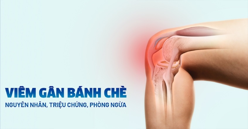 Viêm gân bánh chè