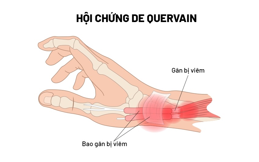 Hội chứng De Quervain