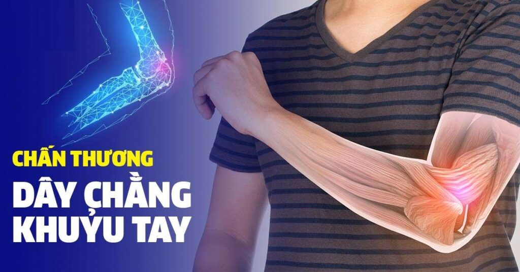 giãn dây chằng khuỷu tay