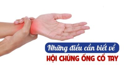 Hội Chứng Ống Cổ Tay