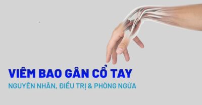 Viêm Bao Gân Cổ Tay