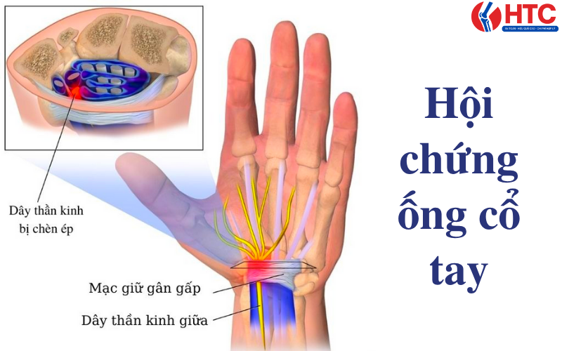 chấn thương bàn tay khi chơi cầu  lông