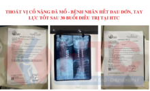 THOÁT VỊ cổ nặng đã mổ - BỆNH NHÂN HẾT ĐAU ĐỚN, tay lực tốt SAU 30 BUỔI ĐIỀU TRỊ tại htc
