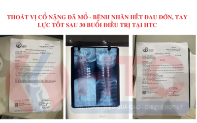 THOÁT VỊ cổ nặng đã mổ - BỆNH NHÂN HẾT ĐAU ĐỚN, tay lực tốt SAU 30 BUỔI ĐIỀU TRỊ tại htc