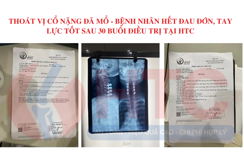 THOÁT VỊ cổ nặng đã mổ - BỆNH NHÂN HẾT ĐAU ĐỚN, tay lực tốt SAU 30 BUỔI ĐIỀU TRỊ tại htc