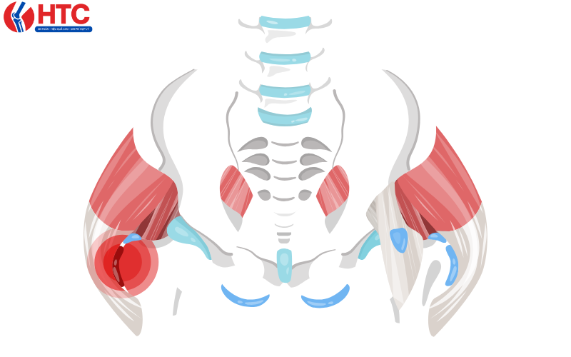 Viêm bao hoạt dịch khớp háng