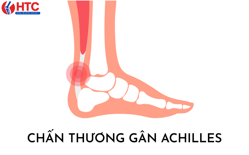 nguyên nhân gây đau gót chân khi chơi thể thao