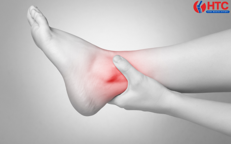 triệu chứng bong gân mắt cá chân