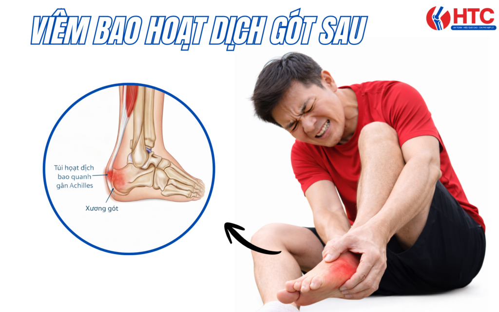 Viêm bao hoạt dịch gót sau