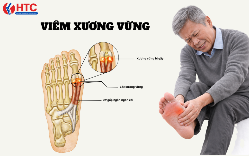 Viêm xương vừng