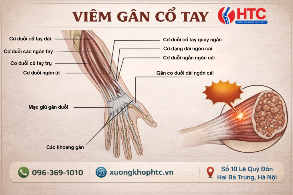 Viêm Gân Cổ Tay