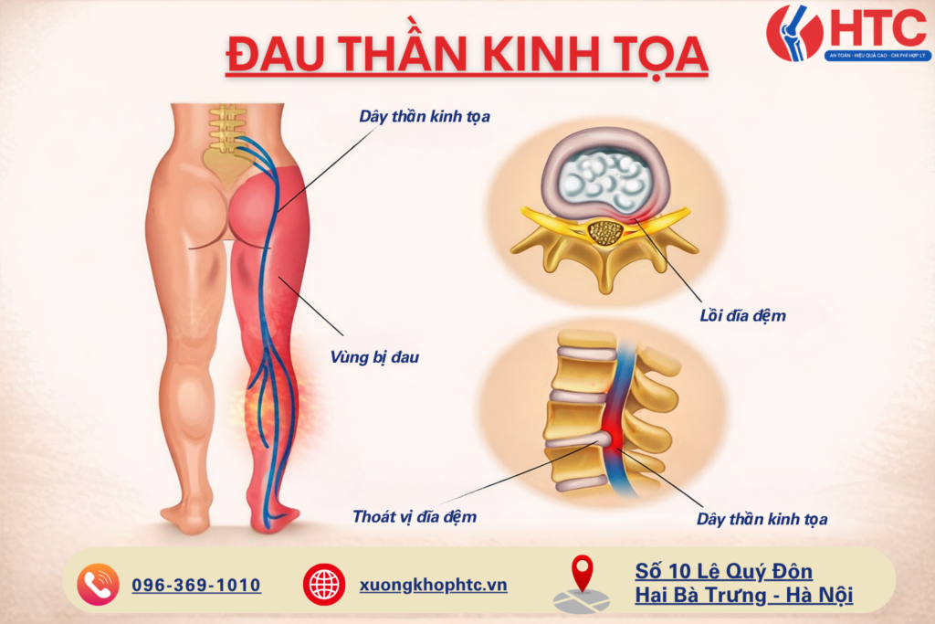 Đau Thần Kinh Tọa