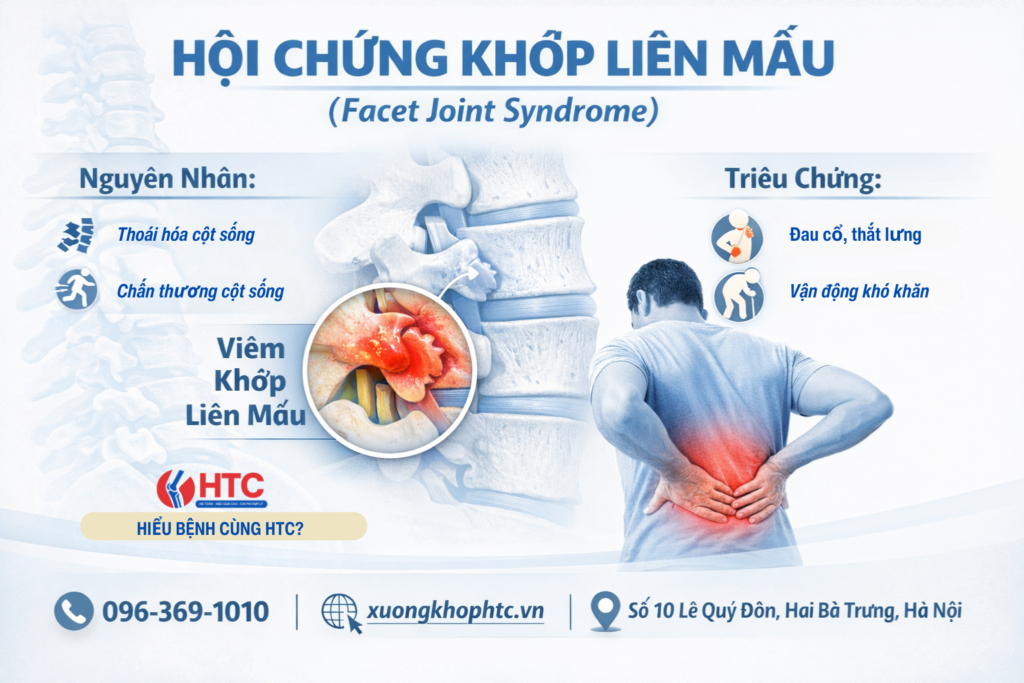 Hội chứng khớp liên mấu (Facet Joint Syndrome)
