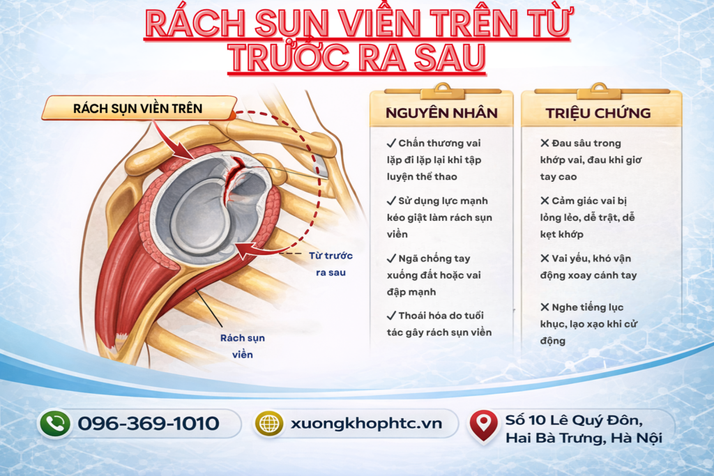Rách Sụn Viền Trên Từ Trước Ra Sau